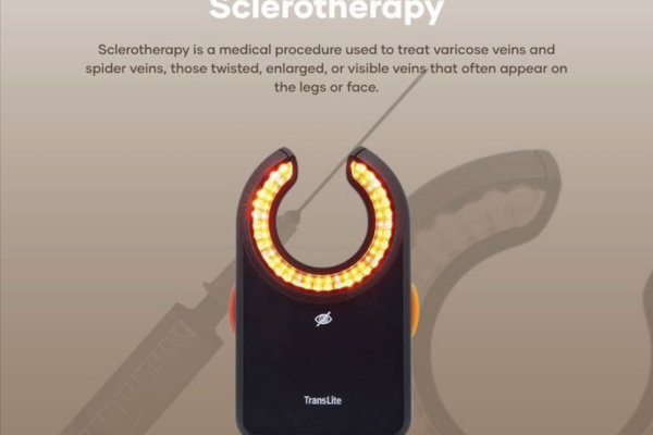 More Filipinos now seeking treatment for varicose veins, and it's not just about appearance